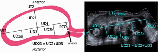 Uterine segmentation and volume measurement  {faces}